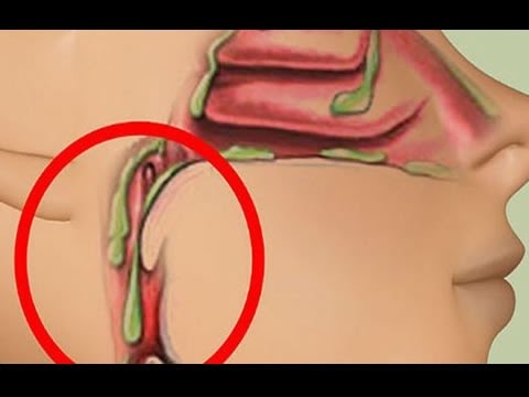 Garganta inflamada y tos con flemas
